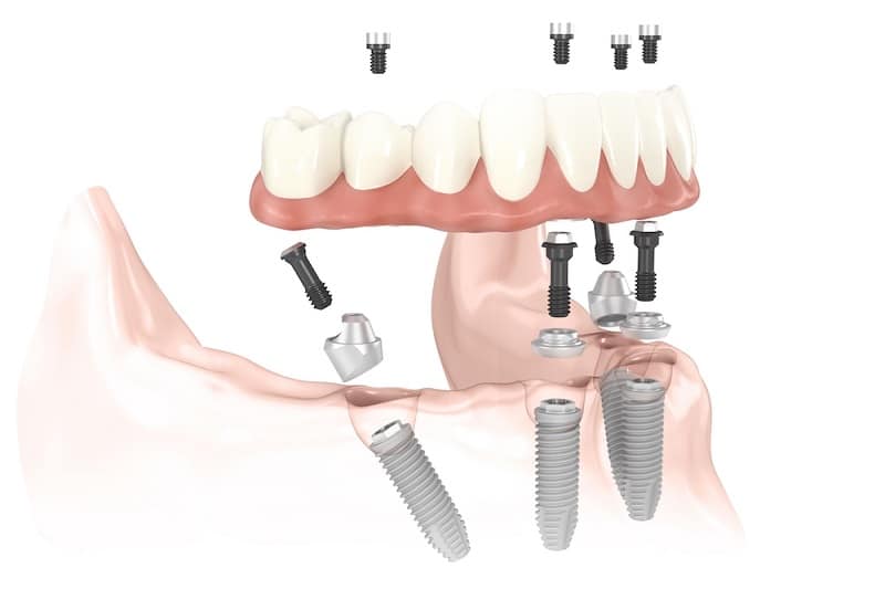 Implanty bez względu na wiek? Tłumaczy dr Marcin Graboń z Dental Med